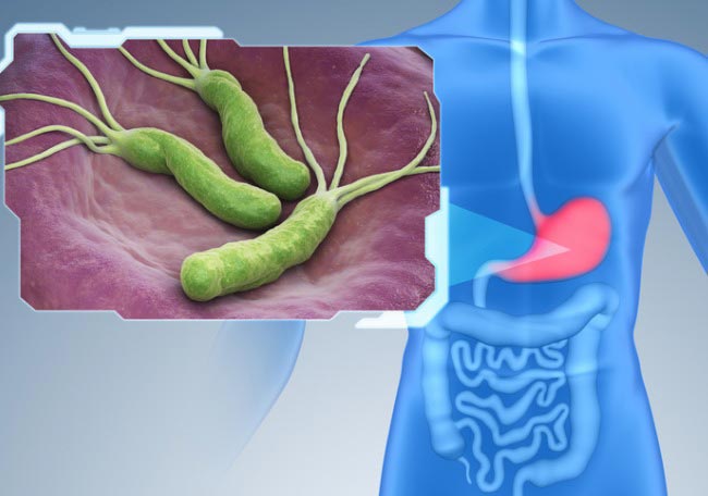 Infeccion-por-Helicobacter-pylori-1 - Noticias al Despertar